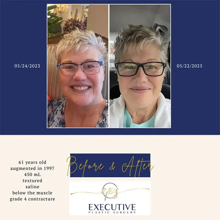 Before and after photos of a 61-year-old patient: left photo dated 05/24/2023 shows her before breast implant removal; right photo dated 05/22/2025 shows her two years post-removal